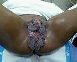Blue Waffle Disease Blue Waffle Infection Blue Waffle Pictures Is Blue ...