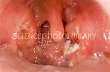 Tonsillitis - Stock Image M270/0320 - Science Photo Library