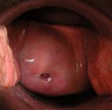 Cervix of a 62 year old woman