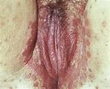 Bleeding vagina yeast infection - Porn Pictures Archive