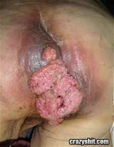 of all infected with genital warts have other stds already