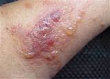 Syphilis Rash Image-Syphilis Rash Pictures (1)