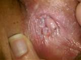 have A LOT of white cluster-like bumps inside my vagina. they ...