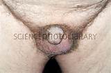 Shrunken penis in prostate cancer patient - Stock Image C011/1717 ...