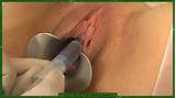 Her pussy gets speculum and pee hole pain