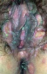 This is one nasty Pussy. It's also known as the Blue Waffle...
