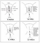 ... in the article is that there are three types of female circumcision