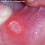 Mouth Infection Picture