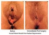 Examples of Vaginal Rejuvenation