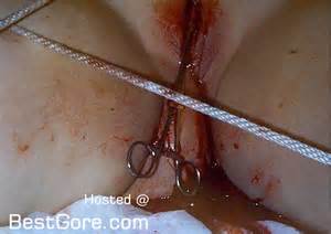 Surgical Tools used to Perform Labiaplasty on a Dumb Woman | Best Gore