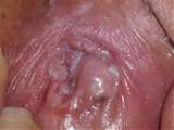 have A LOT of white cluster-like bumps inside my vagina. they