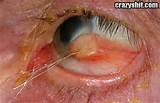 Nasty Eye Infection - Crazyshit.com