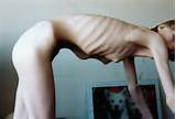 anorexic nude sex picture