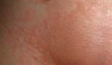 ... area with redness and blisters minutes after fourth laser hair