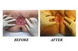 Vaginal cosmetic surgery before and after pictures wallpapers