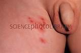 Shingles rash - Stock Image M260/0298 - Science Photo Library