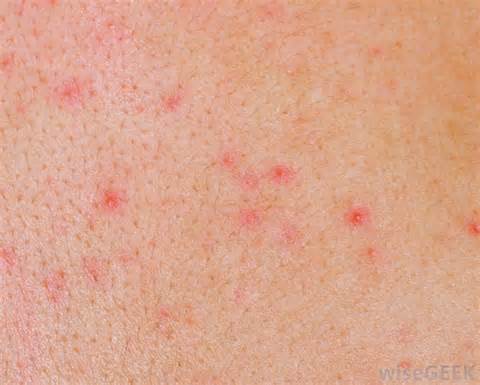 Stress may trigger hives, which are very itchy.