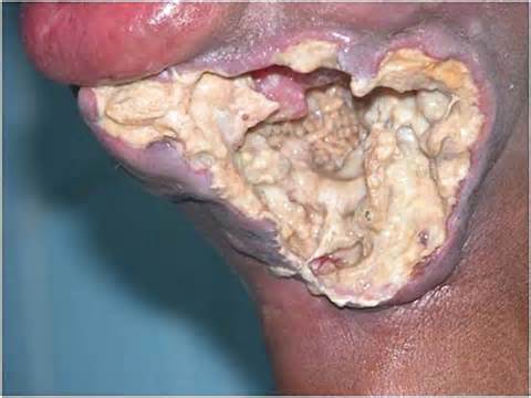 Thread: Cancer of the mouth with maggots inside...