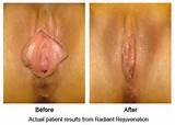 The photos show Vaginal Rejuvenation, a correction for loose vagina