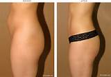 Brazilian Buttock Lift â€“ Before and After Pictures