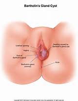 Bartholin's Gland Cyst: Illustration