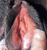 female gonorrhea infection on vagina