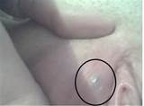 bump on vaginal, bump vaginal, bumps vaginal, bumps on vaginal ...