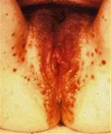 female primary syphilis infectious lesions