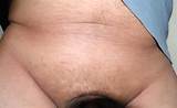 ãƒ•ã‚¡ã‚¤ãƒ«:Laser-hair-removal-lower-abdomen-male.jpg