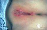 Genital Herpes Blisters On and Around Vagina