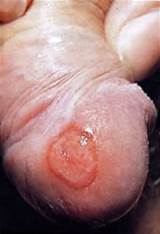 male primary syphilis infection treponema pallidum virus on pecker