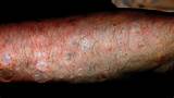 Skin popping scars â€“ a telltale sign of past and present ...