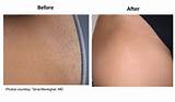Laser Hair Removal Photos â€“ Before & After Laser Hair Removal Images ...