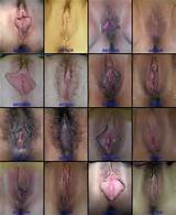 Pussy Lips medical plastic surgery before and after
