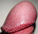 Pearly Penile Papules