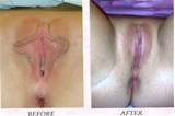 ... photos of labiaplasty, vaginal rejuvenation and hymen reconstruction