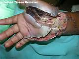 Infected Hand