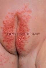 Nappy rash due to Candida infection - Stock Image M220/0036 - Science ...