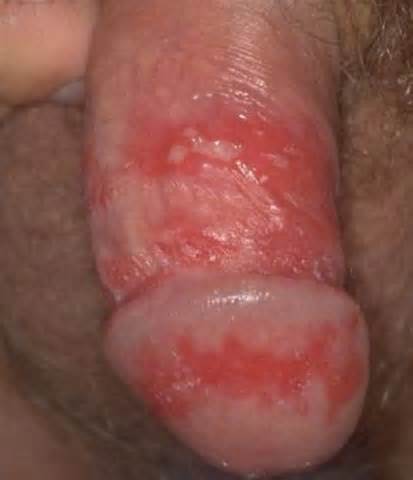 das ist herpes labialis / unten herpes genitalis